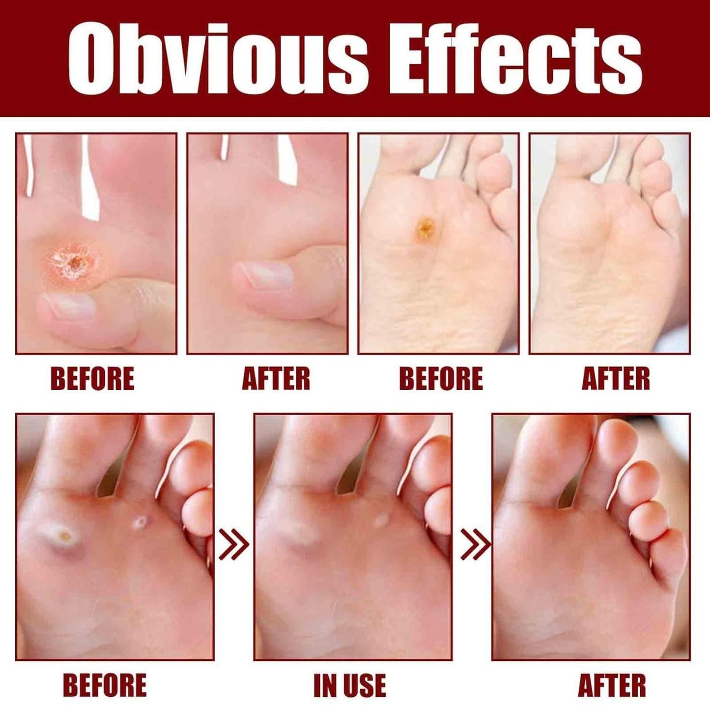 FEET CORN REMOVAL SERUM